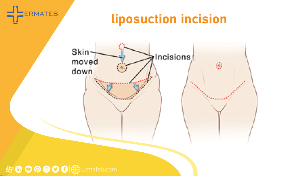 liposuction incision